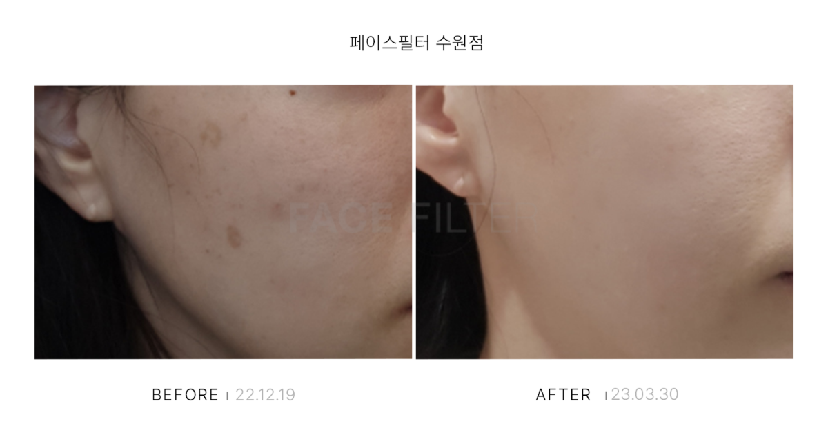 [레이저::피코슈어]