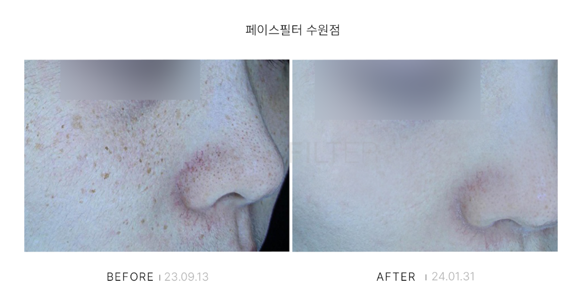 [레이저::피코슈어]