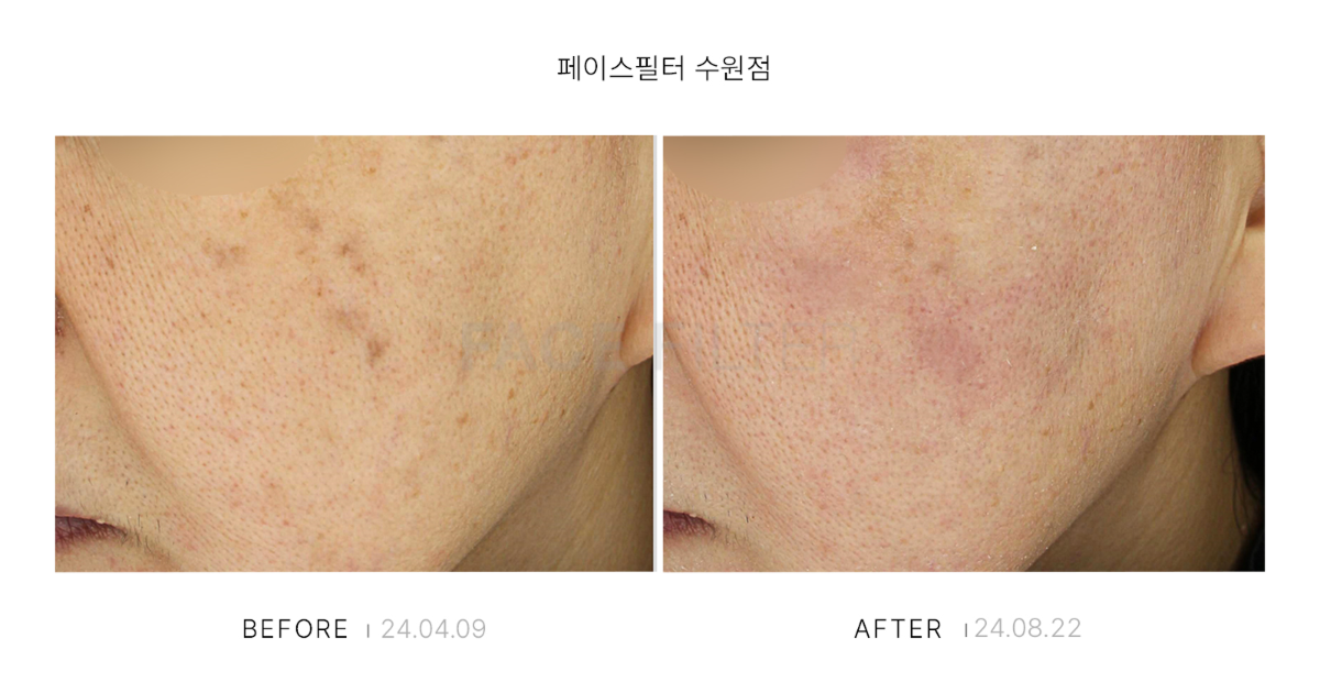 [레이저::FACE POT(리팟)]