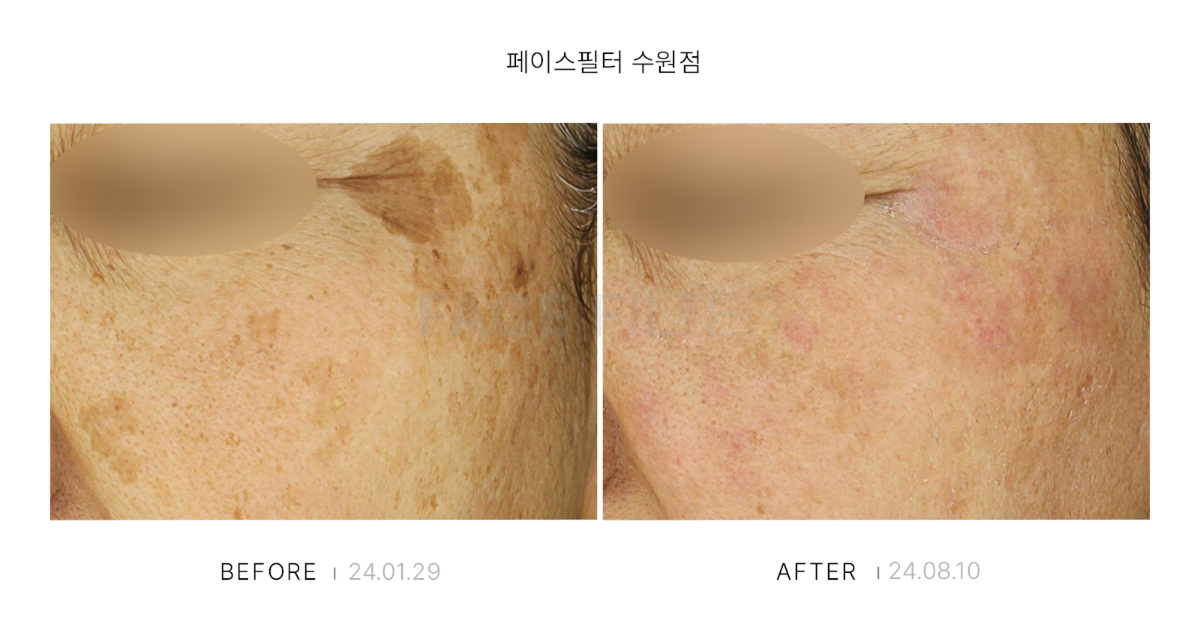 [레이저::FACE POT(리팟)]