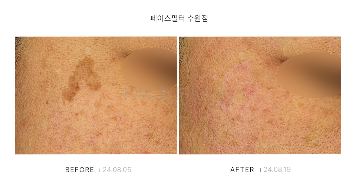 [레이저::FACE POT(리팟)]